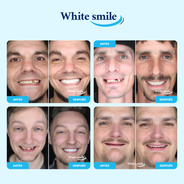 Dientes postizos de aspecto realista: WhiteSmile - Imagen 3